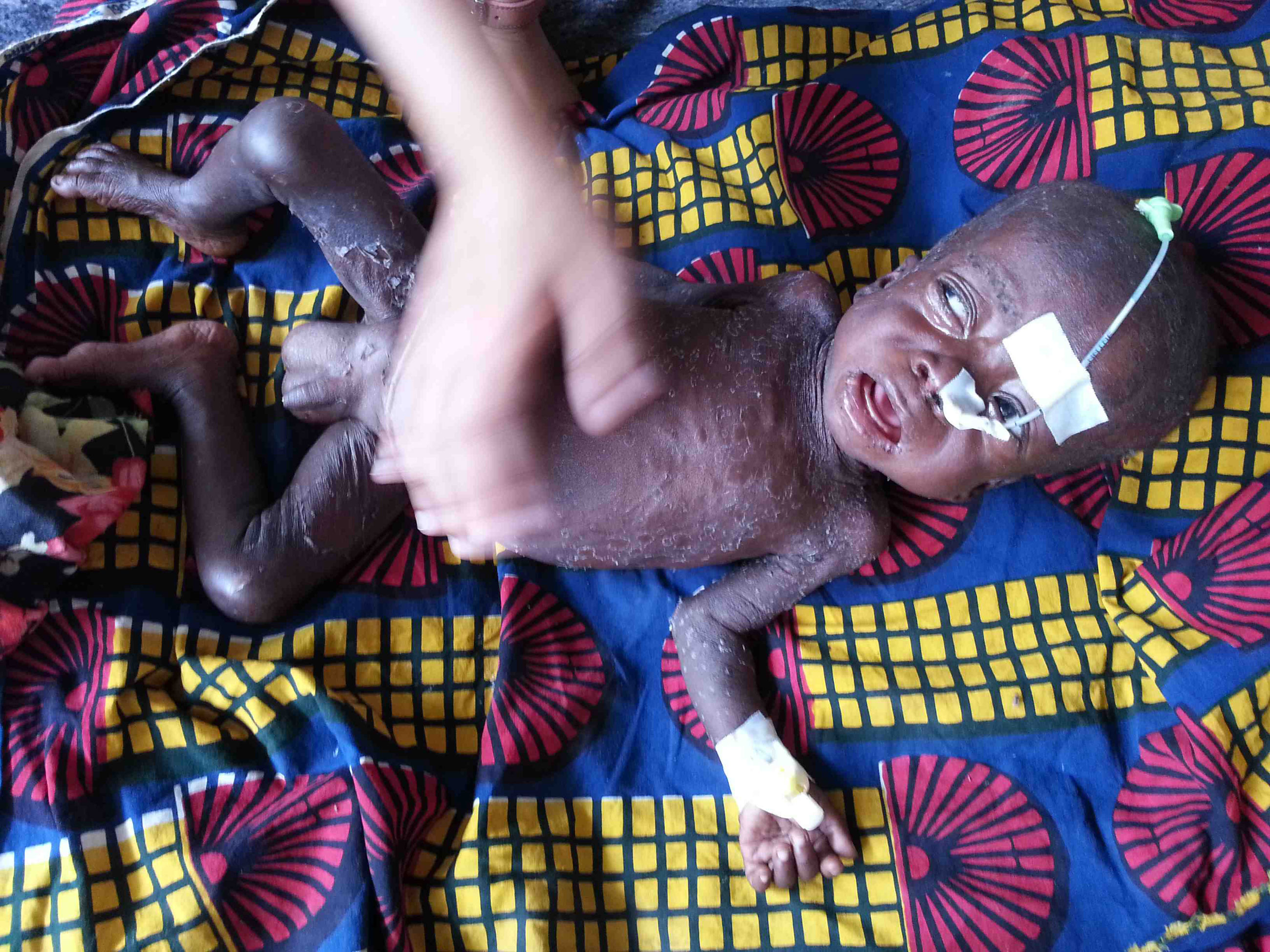 Malaria, mässling och malnutrition (undernäring) är tre mycket vanliga sjukdomar hos barn i Katanga, Kongo-Kinshasa. 