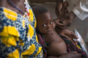 En liten pojke i Mali undersöks av läkare. Han har diagnostiserats med lunginflammation och undernäring. 